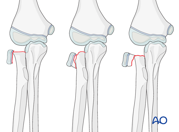 concept of fracture treatment and long term restoration of arm function