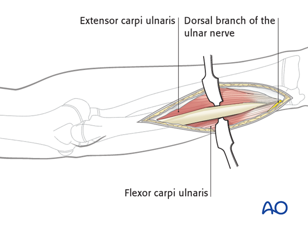 compartment syndrome