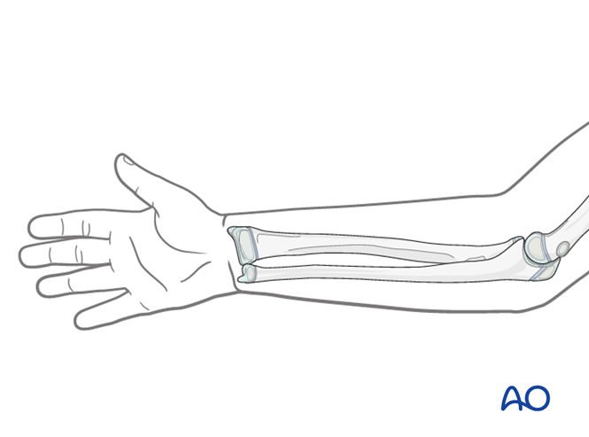 Safe zones for pin placement in the pediatric ulna