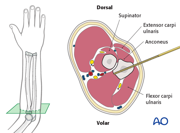 This cross-section illustrates a pin inserted into the proximal ulna.