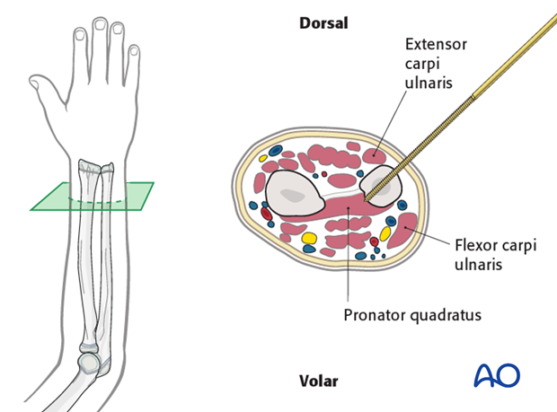 This cross-section illustrates a pin inserted into the distal ulna.