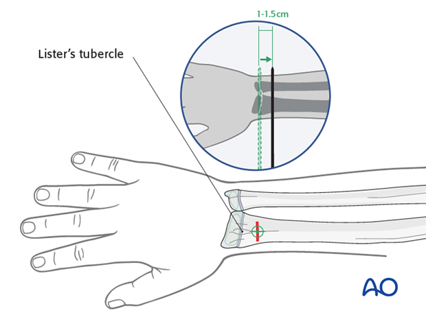 Lister’s tubercle entry point for the radius