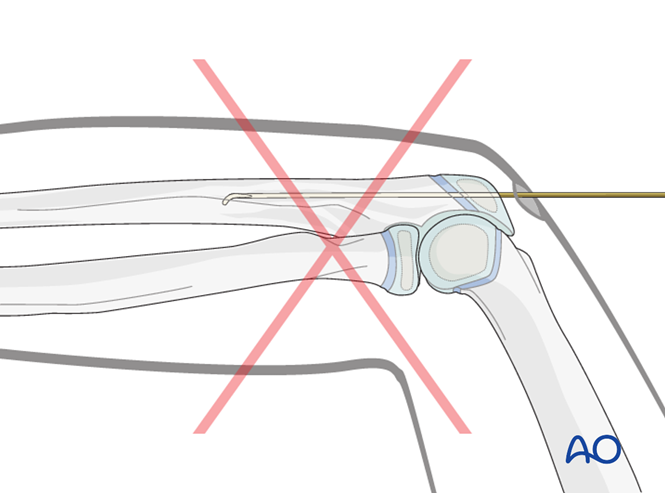 ESIN entry points (pediatric ulna)
