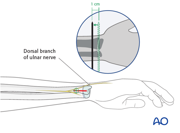 Distal medial entry point for the ulna