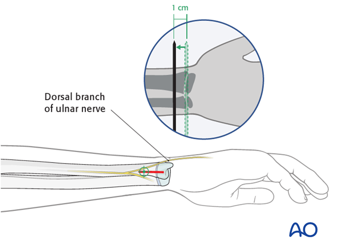 ESIN entry points (pediatric ulna)