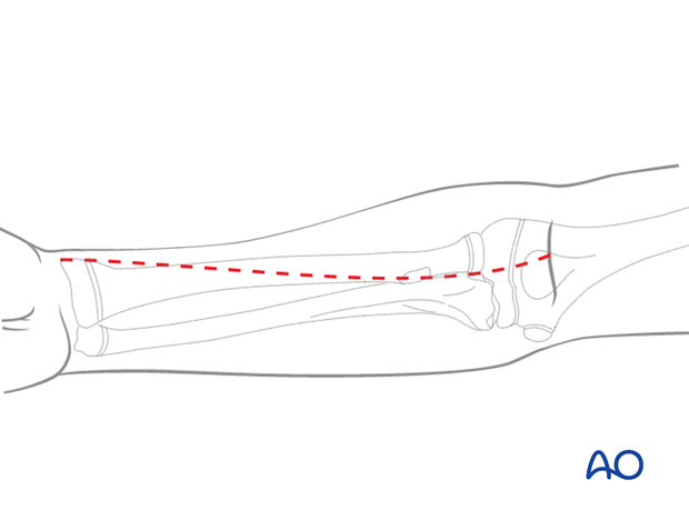 The anterior (Henry) approach offers good exposure of the whole length of the radius.