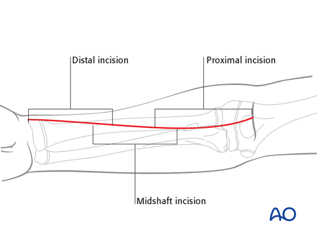 This illustration shows the extent of the incisions for the anterior approaches to the radial shaft.