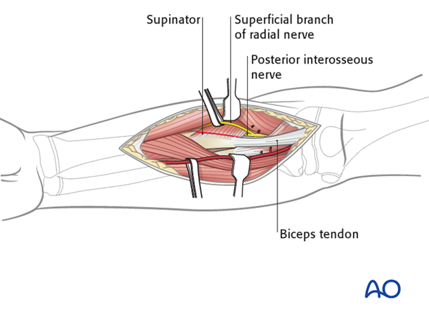 Deep dissection - proximal third