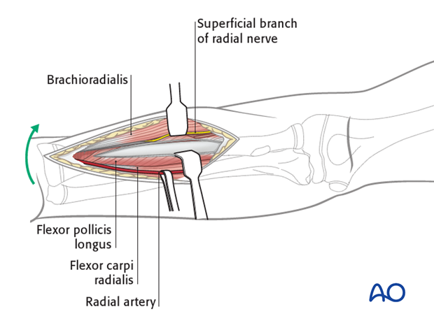 Deep dissection - distal third