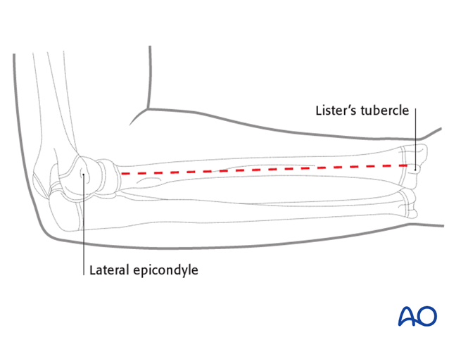 Posterolateral (Thompson) approach to the pediatric radius
