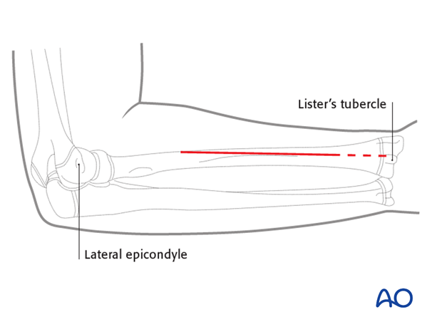 This illustration shows the extent of the posterolateral approach to the middle third of the radial shaft with an extension to its distal third.