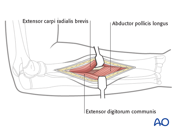 Exposure of the supinator and abductor pollicis longus