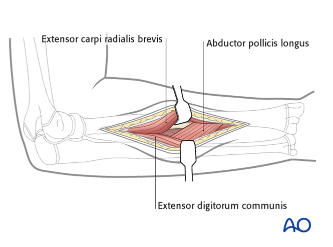 Posterolateral (Thompson) approach to the pediatric radius