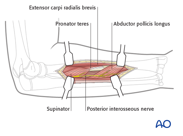 Exposure of the supinator and abductor pollicis longus