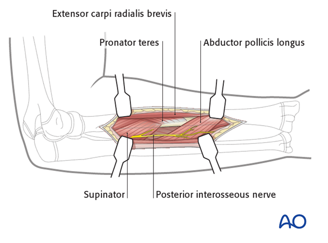 Posterolateral (Thompson) approach to the pediatric radius