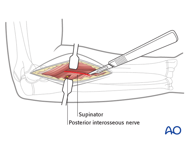 Deep dissection - extension to proximal third