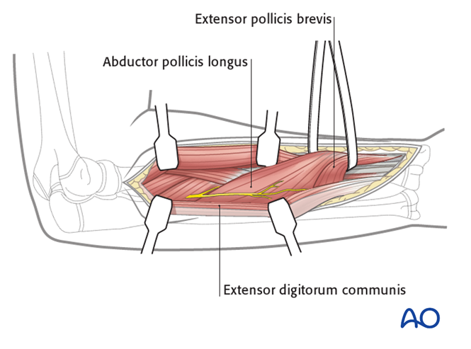 Posterolateral (Thompson) approach to the pediatric radius