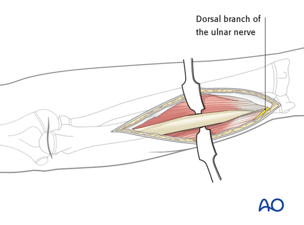 In a very distal extension of the ulnar approach, take care to avoid injury to the dorsal branch of the ulnar nerve.