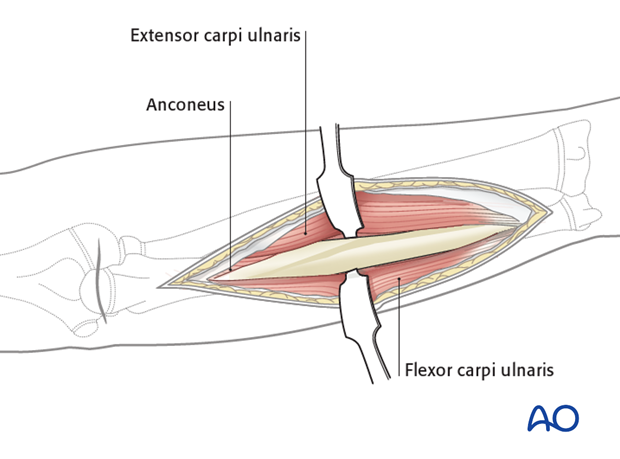 Direct approach to the ulna