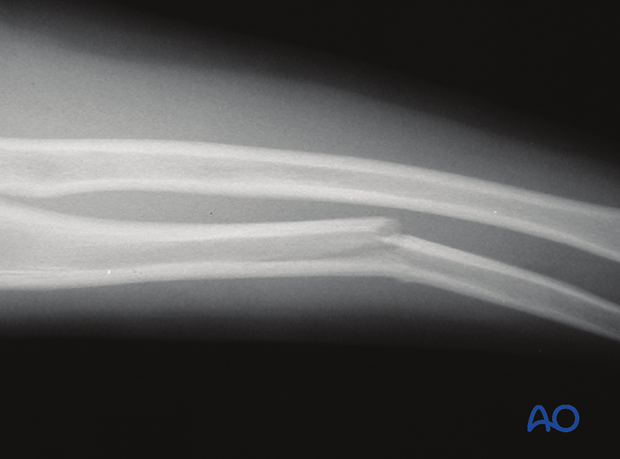 X-ray of forearm shaft injury excluding the adjacent joints