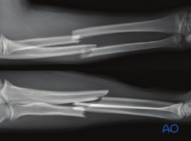 Transverse fracture of the radius and oblique fracture of the ulna, with both bones in apposition