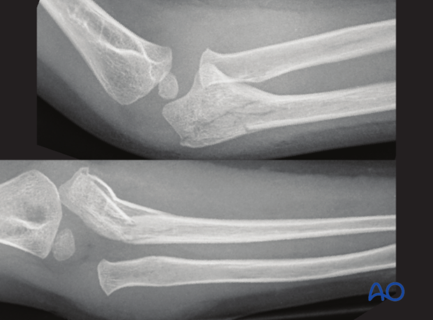 Monteggia lesion with proximal (metaphyseal) ulnar fracture