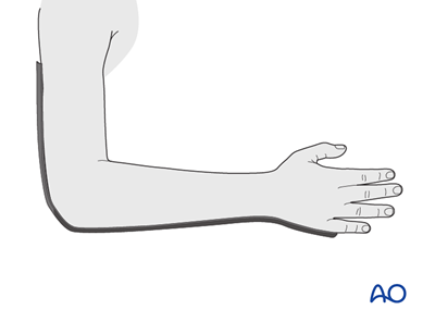 Cast or splint fixation without reduction for Ulna, bowing