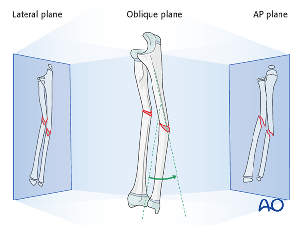 Most fractures have a single oblique plane.