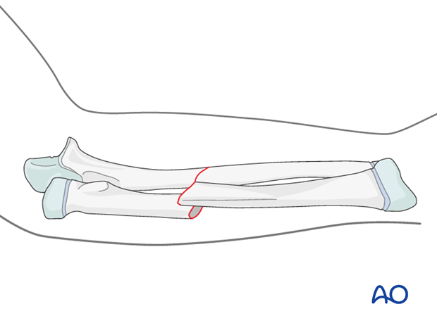 Bayonet apposition of a transverse fracture