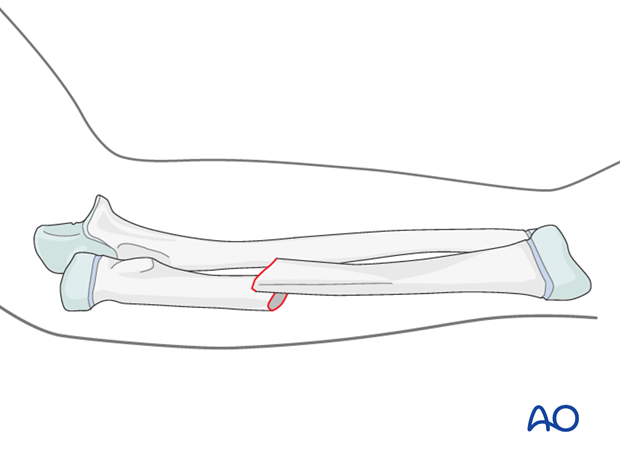 Bayonet apposition of a transverse fracture