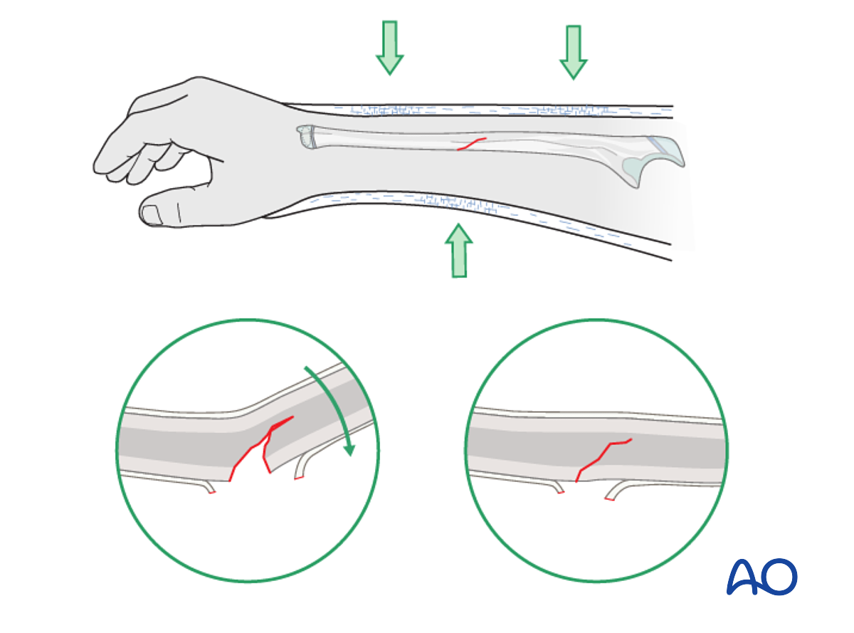 Closed Reduction Cast Or Splint Fixation For Ulna Greenstick Closed Reduction Cast Or Splint Fixation For Ulna Greenstick