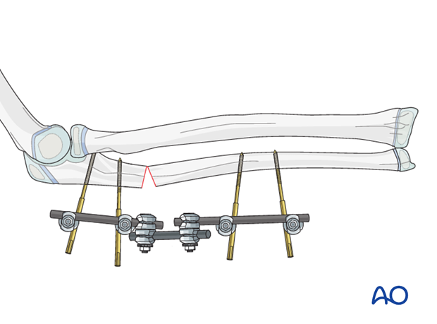 Proximal ulnar osteotomy with overcorrection