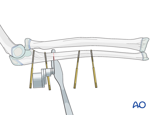 Completion of osteotomy