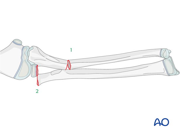 Reduction and fixation of the ulnar shaft fracture