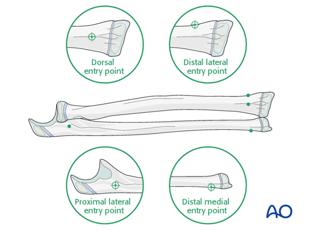 Entry points for ESIN on both bones