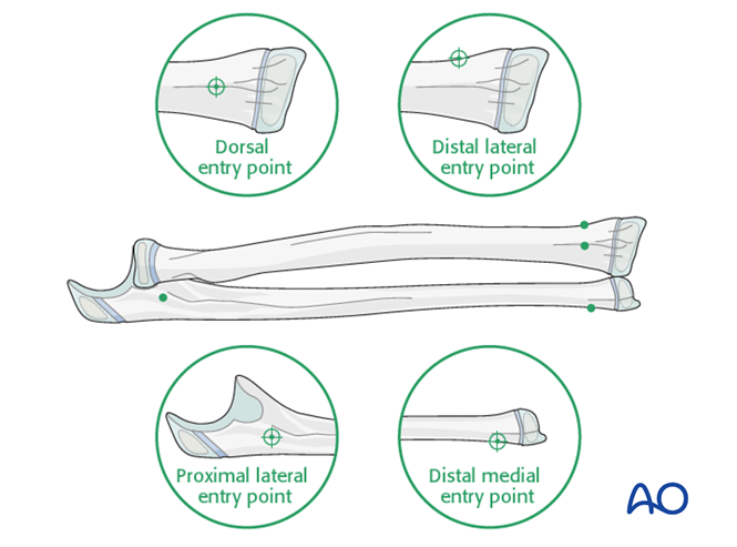 ESIN for Both bones, combination of radial and ulnar fracture