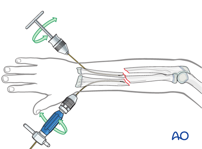 ESIN for Both bones, combination of radial and ulnar fracture
