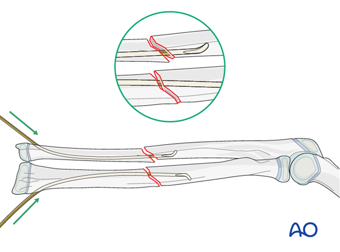 ESIN for Both bones, combination of radial and ulnar fracture