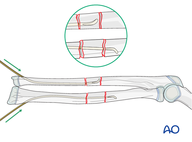 ESIN for Both bones, combination of radial and ulnar fracture