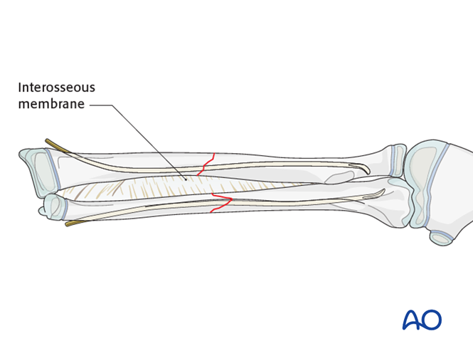 ESIN for Both bones, combination of radial and ulnar fracture