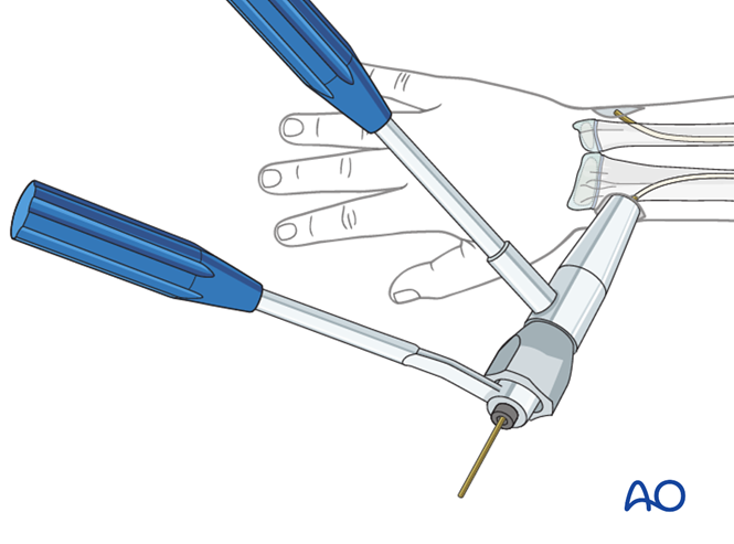 ESIN for Both bones, combination of radial and ulnar fracture