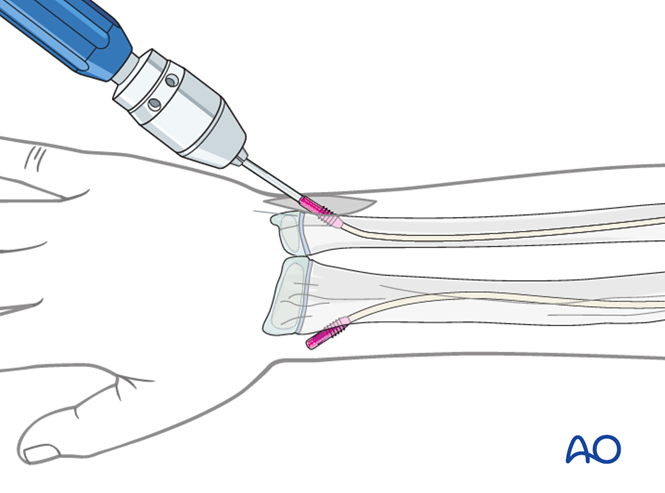 ESIN for Both bones, combination of radial and ulnar fracture