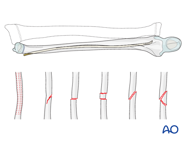 Reduction and fixation of the ulna