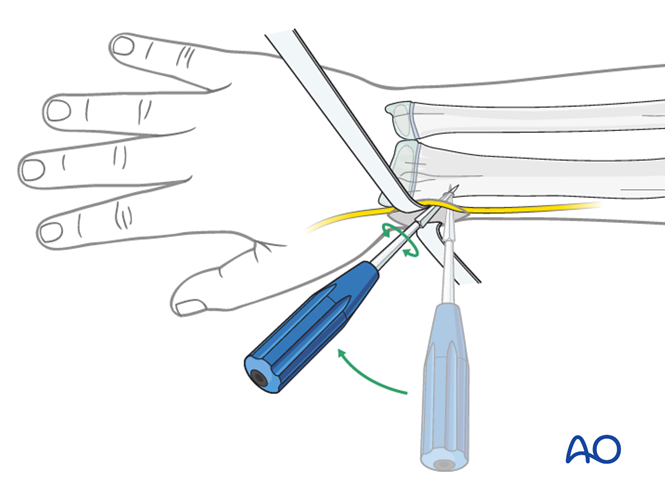 ESIN for Both bones, combination of radial and ulnar fracture