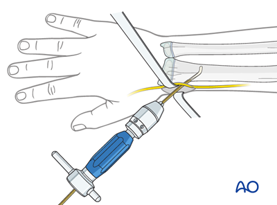ESIN for Both bones, combination of radial and ulnar fracture