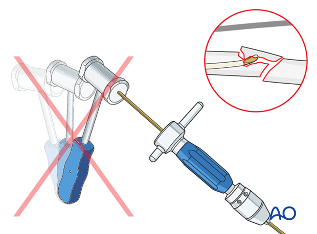 Do not use a hammer if the nail is stuck as this risks iatrogenic fracture.