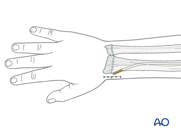 Wound closure