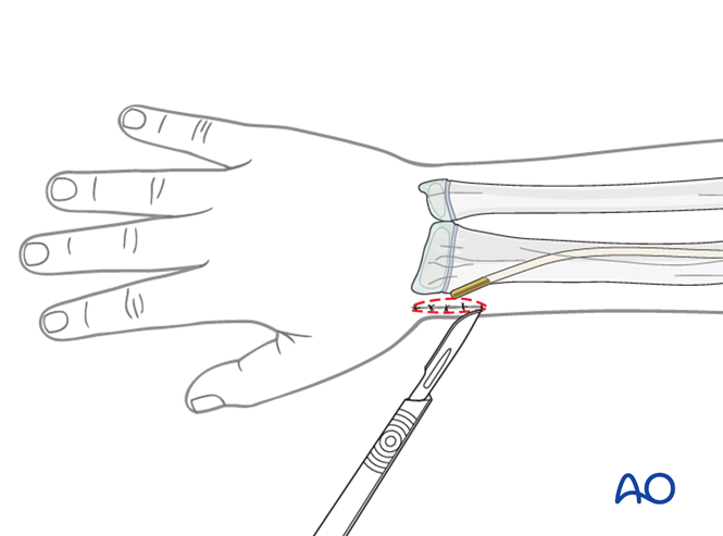 ESIN for Radius, complete oblique or spiral