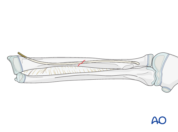 The ESIN method involves closed reduction and internal fixation with an elastic nail.