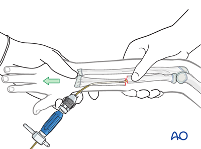 ESIN for Radius, complete transverse, simple